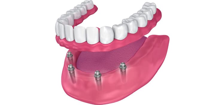 prosthodontie